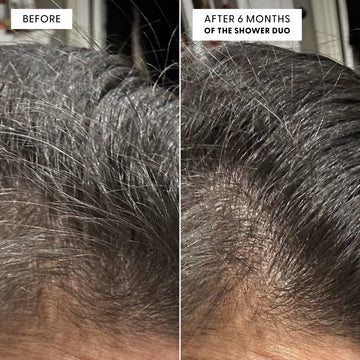 Before and after close-up photo showing grey hair reduction results from arey. Left panel labeled "BEFORE" shows very grey, coarse hair at the crown. Right panel labeled "AFTER 6 MONTHS OF THE SHOWER DUO" shows the same area with noticeably less grey hair and darker pigmented regrowth visible at the crown.