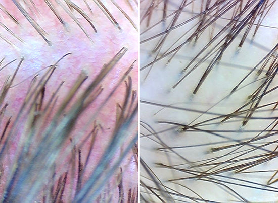 before and after of scalp using calm it down