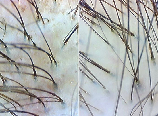 before and after of scalp using calm it down