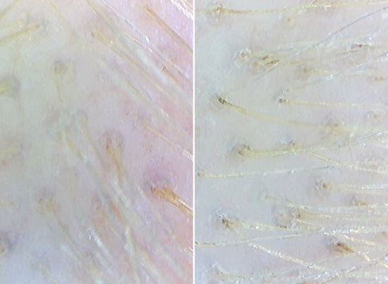 before and after of scalp using calm it down