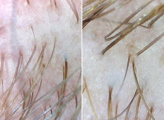 before and after of scalp using calm it down