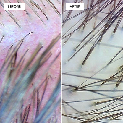 Close-up trichoscopy before and after comparison of scalp and hair follicles. Left (BEFORE) shows a reddened, irritated scalp with sparse, thin hair follicles. Right (AFTER) shows a calmer, healthier scalp with denser, stronger hair follicles following Calm It Down treatment.