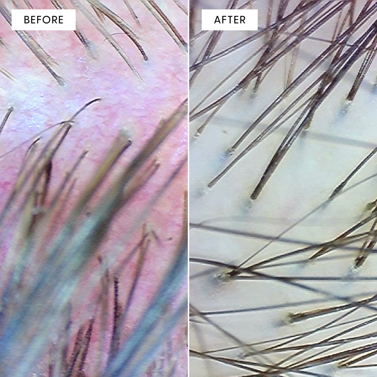 Close-up trichoscopy before and after comparison of scalp and hair follicles. Left (BEFORE) shows a reddened, irritated scalp with sparse, thin hair follicles. Right (AFTER) shows a calmer, healthier scalp with denser, stronger hair follicles following Calm It Down treatment.