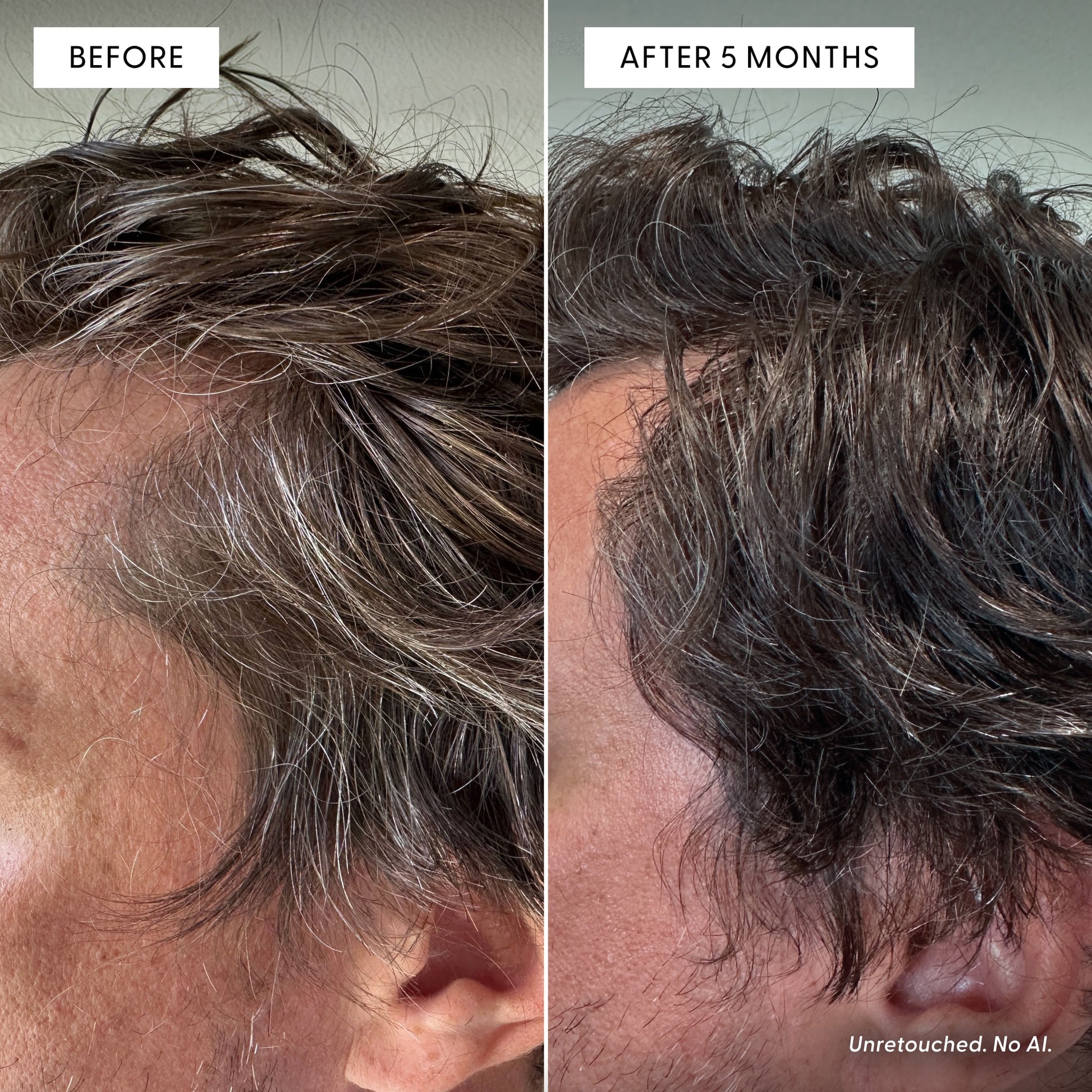 Side-by-side close-ups of a person’s hair: the left image, labeled “Before,” shows more gray hair, and the right image, labeled “After 5 Months of The Dream Duo by Arey,” reveals darker, thicker hair. Bottom right notes: Unretouched. No AI. Results suggest The Dream Duo by Arey may support melanin production to reduce greys and promote thicker hair over time.