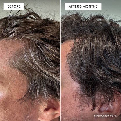Side-by-side close-ups of a person’s hair: the left image, labeled “Before,” shows more gray hair, and the right image, labeled “After 5 Months of The Dream Duo by Arey,” reveals darker, thicker hair. Bottom right notes: Unretouched. No AI. Results suggest The Dream Duo by Arey may support melanin production to reduce greys and promote thicker hair over time.