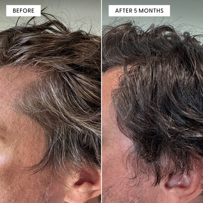 Side-by-side before and after photos of a person's hair. Left panel labeled "BEFORE," right panel labeled "AFTER 5 MONTHS," showing a significant reduction in grey.