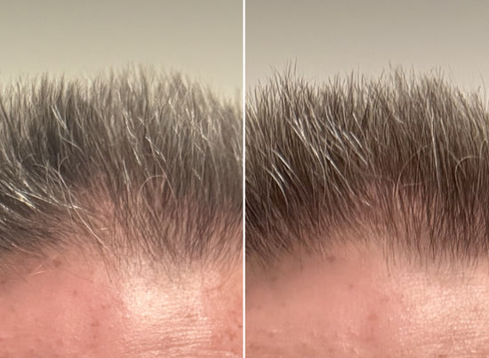 Close-up of a persons hairline, showing a before-and-after comparison. The left side displays thinner hair, while the right side shows thicker, fuller hair growth.
