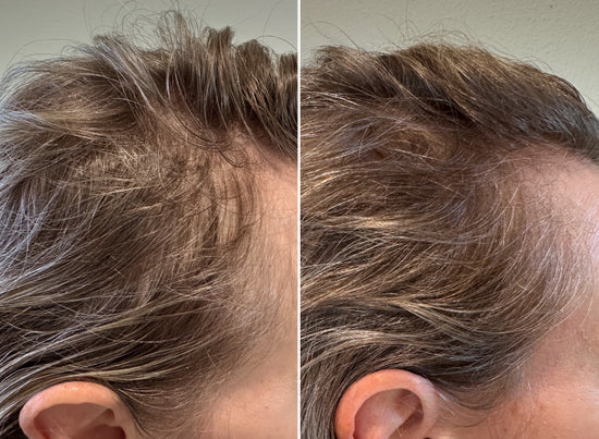 Side-by-side comparison of a persons hairline before and after treatment, showing less hair thinning and improved hair density in the after photo.