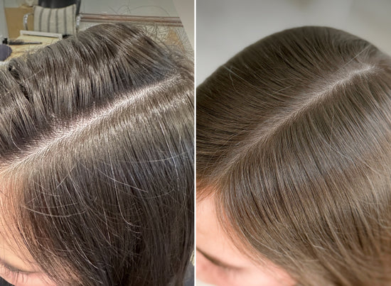Side-by-side close-ups of a persons scalp, showing thinning hair on the left and fuller, healthier hair on the right, highlighting a visible improvement in hair volume and coverage.