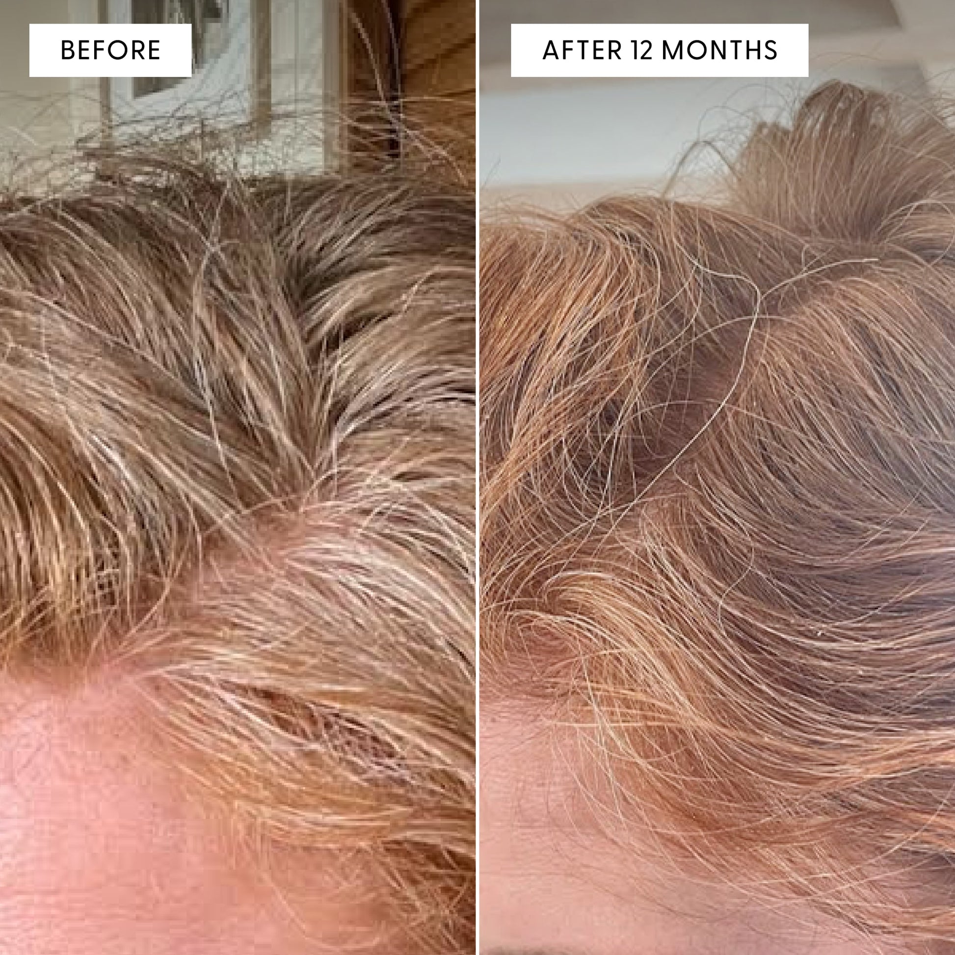 Before and after split photo showing hair results from Arey Not Today Grey. Left panel labeled "BEFORE" shows close-up of hair with visible grey strands at the roots. Right panel labeled "AFTER 12 MONTHS" shows the same area with significantly reduced grey hair and more pigmented, fuller-looking hair.