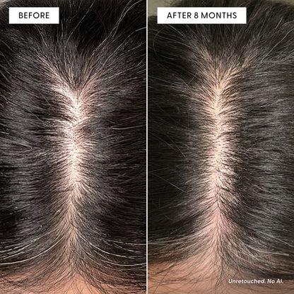 Side-by-side images show a person’s scalp before and after 8 months of using Arey The Root Re-Set. The “before” image reveals visible thinning hair, while the “after” shows noticeably thicker, fuller hair along the part, highlighting improved scalp health. Text states Unretouched. No AI.
