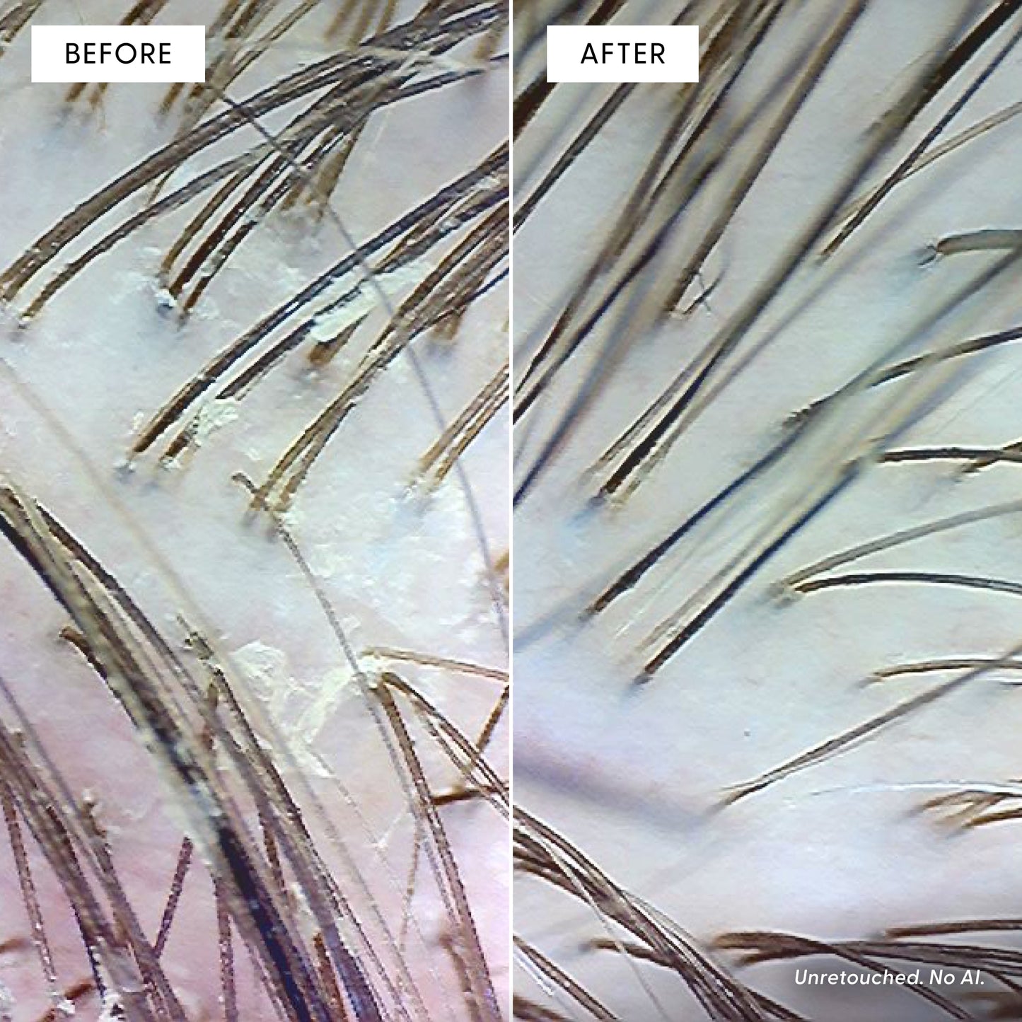 Split image of scalp under magnification: left side labeled Before shows dry flakes and buildup, while right side labeled After, treated with Arey Scrub Scalp Exfoliant with salicylic acid, reveals a cleaner scalp and healthier-looking hair strands. Text at bottom reads, Unretouched. No AI.