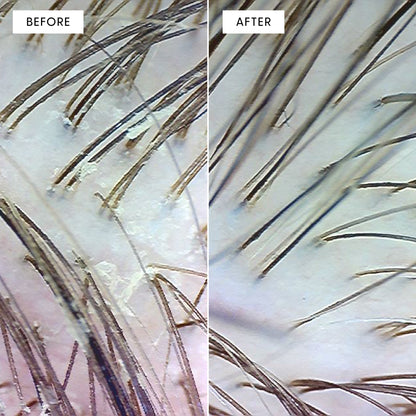 Before and after close-up microscope image of scalp and hair strands using Arey Scalp Scrub. Left labeled BEFORE shows buildup and flaking. Right labeled AFTER shows cleaner, healthier-looking scalp.