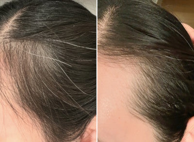 Side-by-side comparison of a persons scalp: the left shows thinning hair, while the right shows a more pronounced receding hairline, illustrating different stages or types of hair loss.