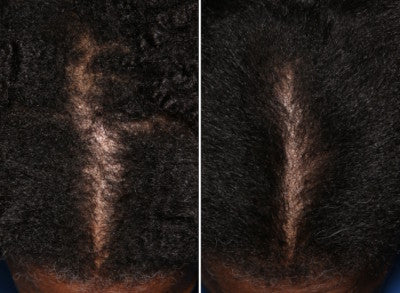 Side-by-side comparison of a scalp with thinning hair on the left and fuller, thicker hair on the right, showing improvement in hair density along the part line.
