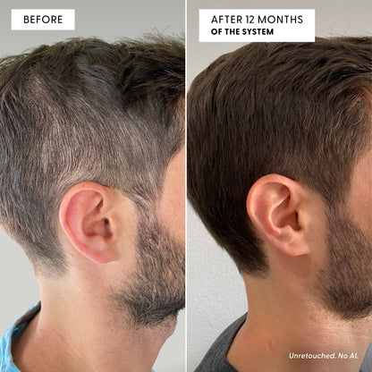 Side-by-side comparison of a man’s head before and after 12 months using The Restorative Kit from Arey, highlighting visibly increased hair density and a more defined hairline in the after image. This advanced formula is specifically designed to support repigmentation and encourage thicker hair. Text reads Unretouched. No AI.