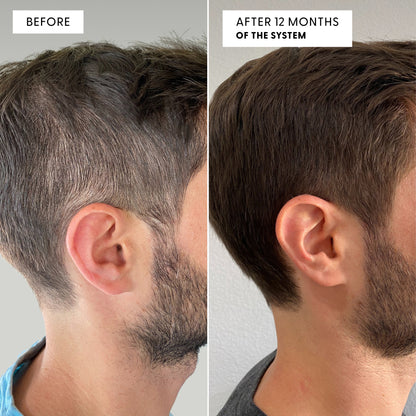Before and after side profile of a man's head showing hair transformation. Left labeled BEFORE shows significant grey at temples and sides. Right labeled AFTER 12 MONTHS OF THE SYSTEM shows visibly darker hair with less grey.