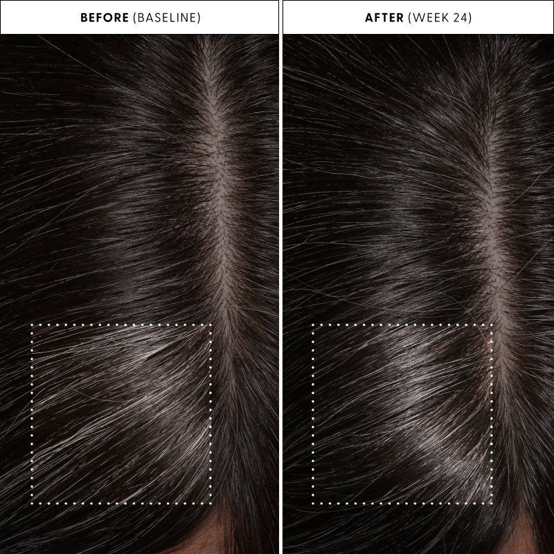 Before (baseline) and after (week 24) close-ups of a real Arey customer's hair part, with the same area outlined in both.