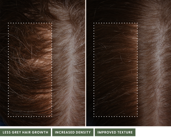 Before and after using The System. After image has noticeably less grey hair growth, increased density, and improved texture