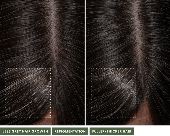 Before and after using The System. After using the system, noticeably less grey hair growth, repigmentation, fuller/thicker hair